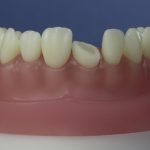 Dentes Diferenciados 145