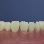Dentes Diferenciados 144