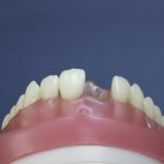 Dentes Diferenciados 138