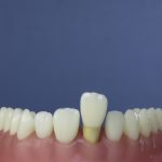 Dentes Diferenciados 134