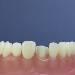 Dentes Diferenciados 118
