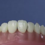 Dentes Diferenciados 115