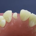 Dentes Diferenciados 114
