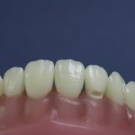 Dentes Diferenciados 132