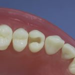 Differentiated Teeth 32