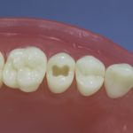 Dentes Diferenciados 31
