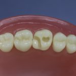 Dentes Diferenciados 30