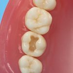 Dentes Diferenciados 126