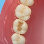 Differentiated Teeth 126