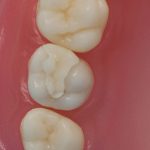 Dentes Diferenciados 125