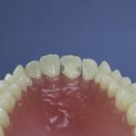 Dentes Diferenciados 86