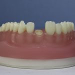 Dentes Diferenciados 152