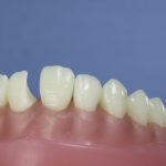 Dentes Diferenciados 95