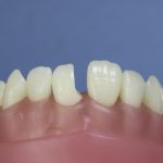 Dentes Diferenciados 94