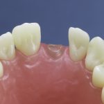 Dentes Diferenciados 93
