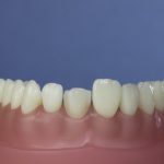 Dentes Diferenciados 79
