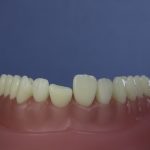 Dentes Diferenciados 82
