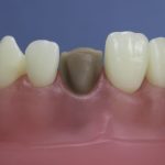 Dentes Diferenciados 80