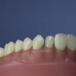 Dentes Diferenciados 76