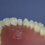 Dentes Diferenciados 75