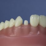 Dentes Diferenciados 74