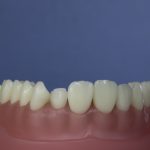 Dentes Diferenciados 72