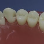 Differentiated Teeth 25