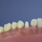 Dentes Diferenciados 66