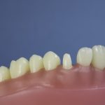 Differentiated Teeth 66