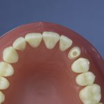 Dentes Diferenciados 65