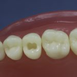 Dentes Diferenciados 23