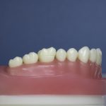 Dentes Diferenciados 124