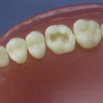 Dentes Diferenciados 61