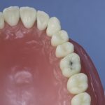 Dentes Diferenciados 155