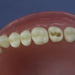 Dentes Diferenciados 64