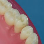 Dentes Diferenciados 54