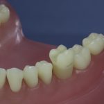 Dentes Diferenciados 13