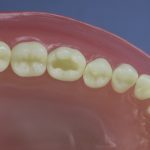 Dentes Diferenciados 51