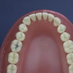 Dentes Diferenciados 154
