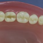 Dentes Diferenciados 47