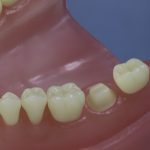 Dentes Diferenciados 46
