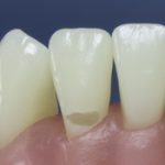 Differentiated Teeth 8