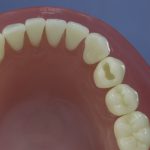 Dentes Diferenciados 43