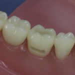 Dentes Diferenciados 2