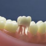 Dentes Diferenciados 37