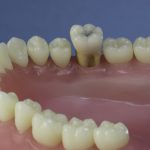 Dentes Diferenciados 35