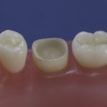 Dentes Diferenciados 146