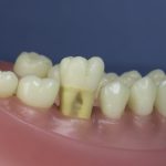 Dentes Diferenciados 38