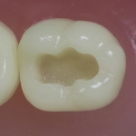 Differentiated Teeth