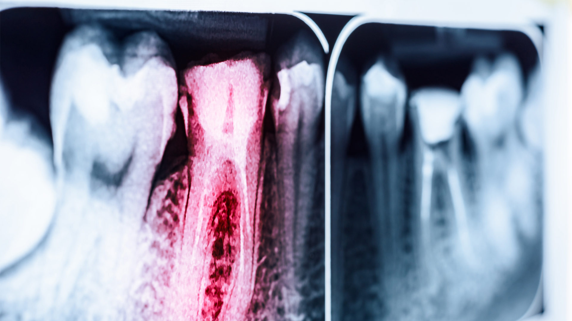 (Português do Brasil) Descubra os Dentes Diferenciados de Endodontia e Cariados da Pronew